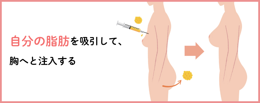 脂肪注入